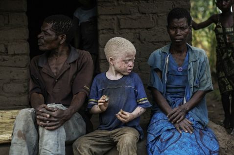Страшна реальність: в Африці людей-альбіносів вбивають, щоб зробити з них амулети