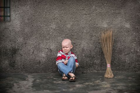 23 драматичних знімка з життя альбіносів. Людей, яким не позаздриш
