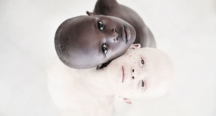 Приголомшливі фото дітей-альбіносів, покликані звернути увагу на жахи їх життя
